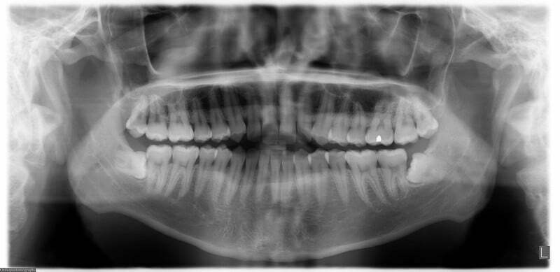 Estimation of age using dental radiographs